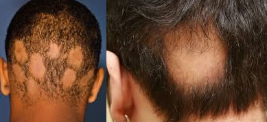 alopecia.jpg