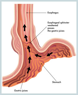 gastric_reflux.jpg