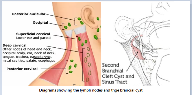 Branciak cyst.PNG