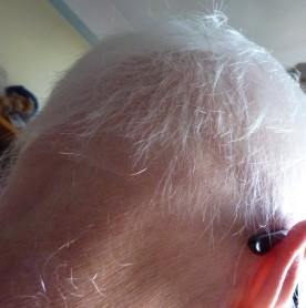 alopecia April 2013-2.jpg