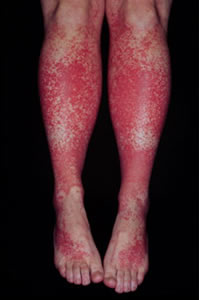 Thrombotic thrombocyotpenic purpura.jpg